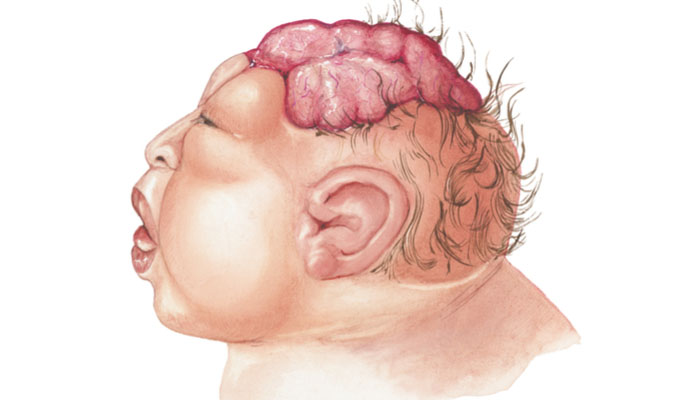 anensefali