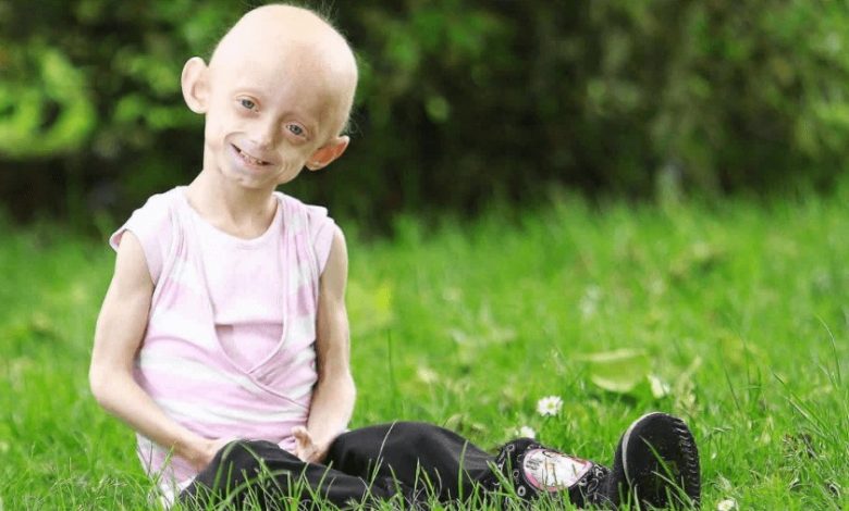progeria