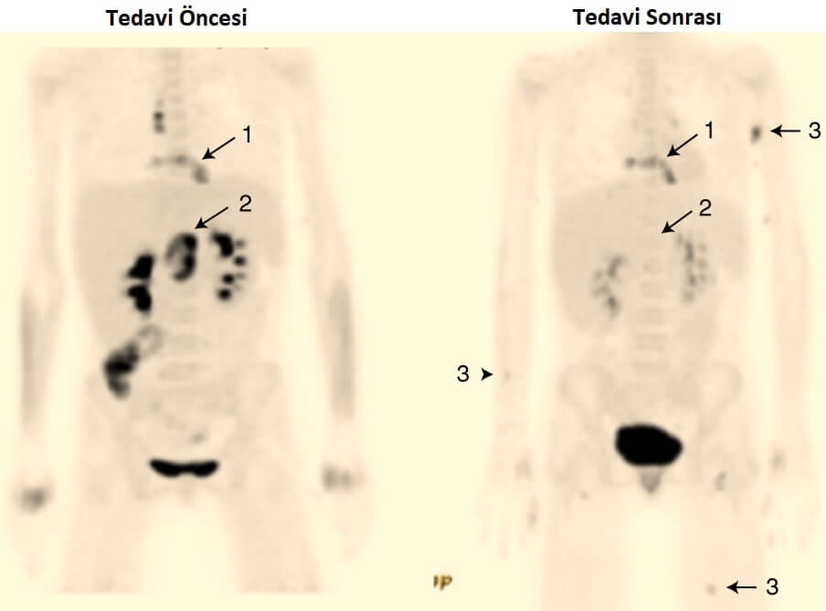 Bakteriyofaj Tedavi Öncesi ve Sonrası