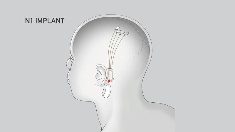 Nörolink N1 İmplantı